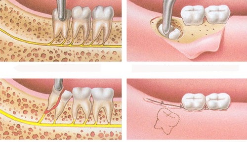 Nhổ răng khôn tại quận 10